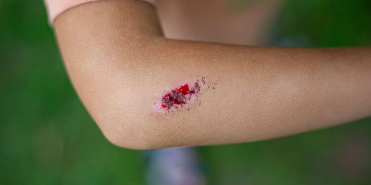 Boala infecțioasă gravă, cu mortalitate ridicată dacă nu este tratată rapid și corect. Sporii care o cauzează pot supraviețui ani de zile