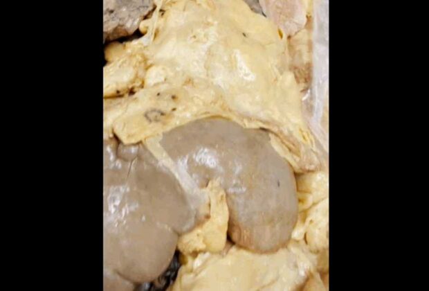 Cum atacă grăsimea viscerală „ascunsă” organele interne: videoclipul viral care șochează internetul. Pericol și pentru persoanele slabe