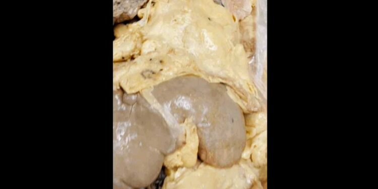 Cum atacă grăsimea viscerală „ascunsă” organele interne: videoclipul viral care șochează internetul. Pericol și pentru persoanele slabe