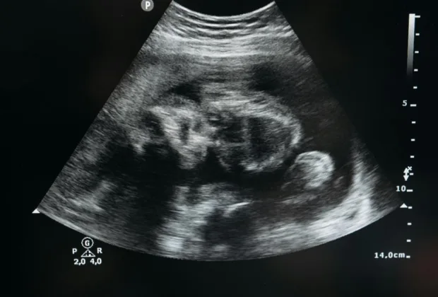 Ce este un lithopedion sau „bebelușul de piatră”? O raritate medicală care fascinează lumea