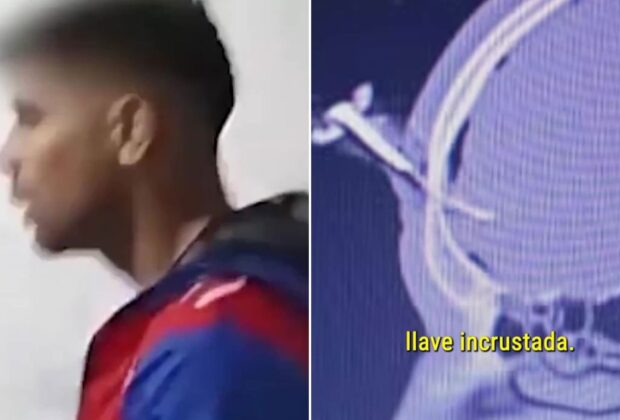 Operat pentru a-i fi extrasă o cheie de mașină înfiptă în cap! Imagini șocante