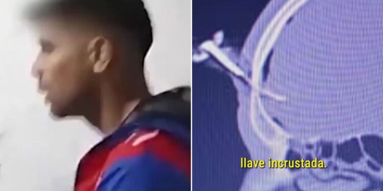 Operat pentru a-i fi extrasă o cheie de mașină înfiptă în cap! Imagini șocante