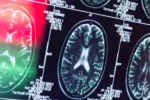 Institutul de Psihiatrie ‘Socola’ introduce un tratament unic în România pentru Alzheimer