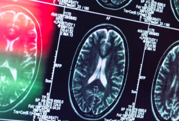 Institutul de Psihiatrie ‘Socola’ introduce un tratament unic în România pentru Alzheimer