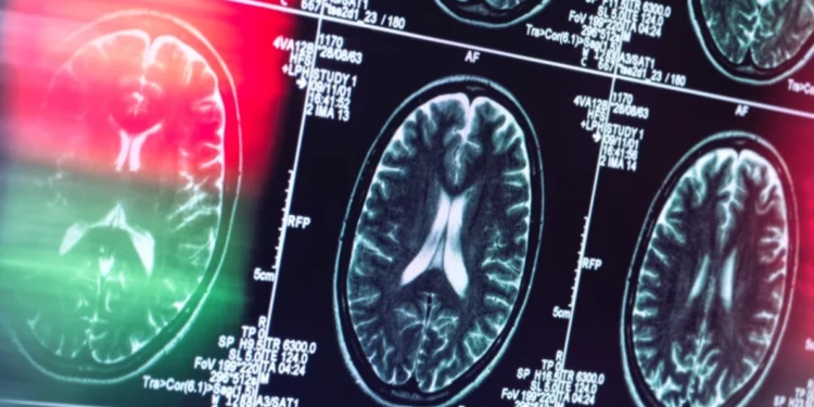 Institutul de Psihiatrie ‘Socola’ introduce un tratament unic în România pentru Alzheimer